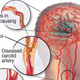 Illustration for article titled Obat Stroke Adalah